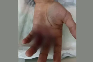 Jovem sofre lesão grave na mão após explosão de bolo de aniversário em Palmas