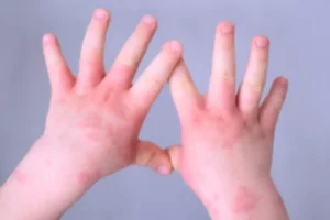 Palmas investiga casos suspeitos de sarampo em bebês de oito meses e um ano