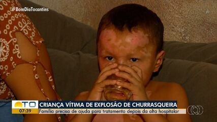 Menino de 5 anos ferido em explosão de churrasqueira deixa hospital em Palmas - Imagem do artigo original
