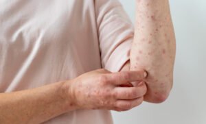 Tocantins registra 16 casos confirmados de sarampo e mantém 14 sob investigação