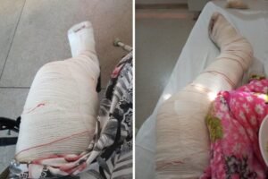 Tocantins registra 4.028 casos de violência contra a mulher em 2025; vítima fratura a perna após agressão do companheiro