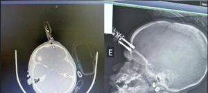 Bebê de 1 ano é operada após cair da cama com carregador cravado na testa em Divinópolis